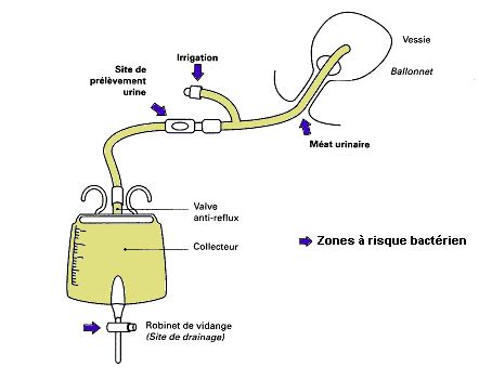 vivre avec une sonde urinaire|Travailler avec une sonde urinaire : avantages, conseils et